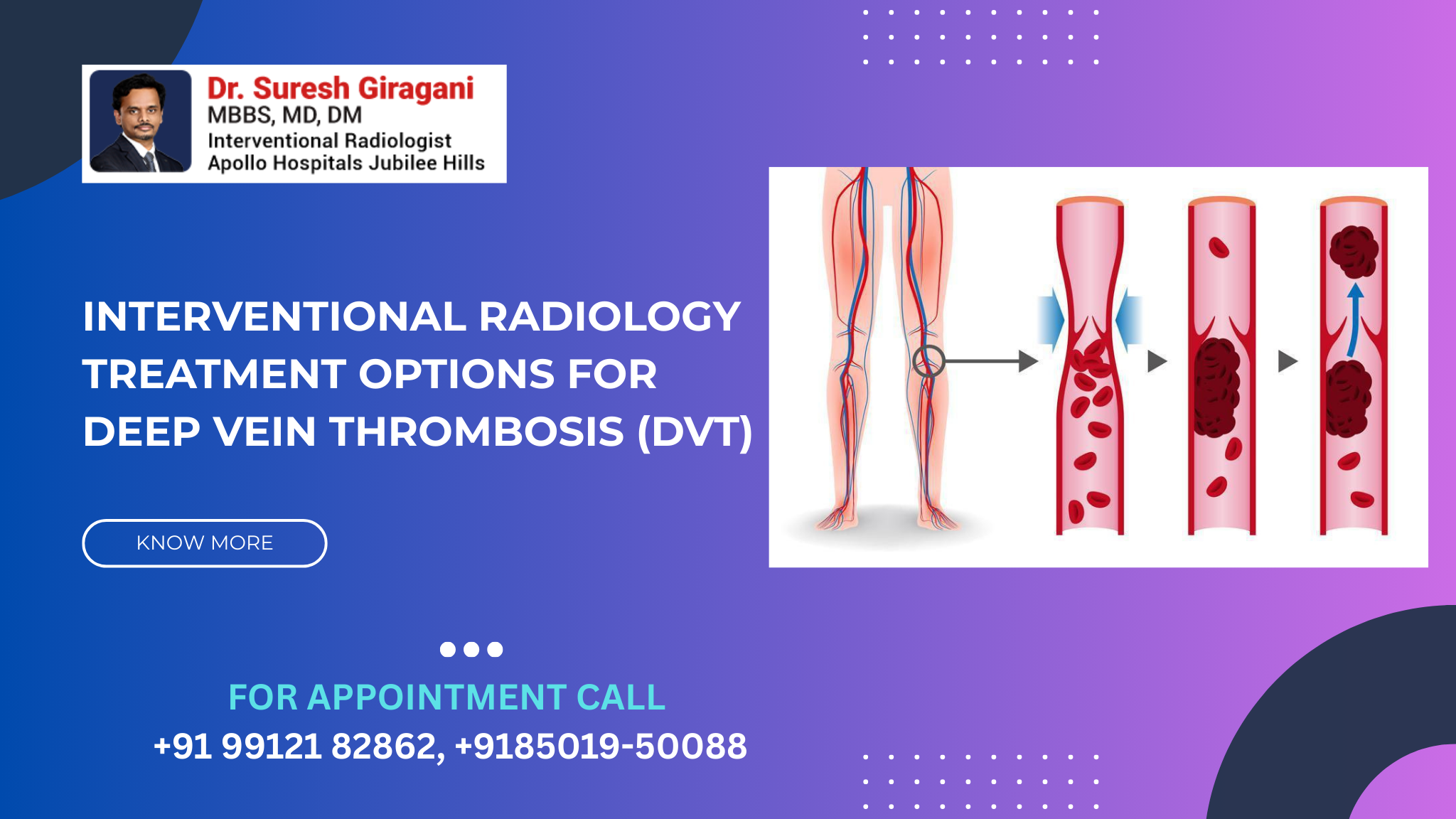 Interventional Radiology Treatment Options for Deep Vein Thrombosis (DVT)