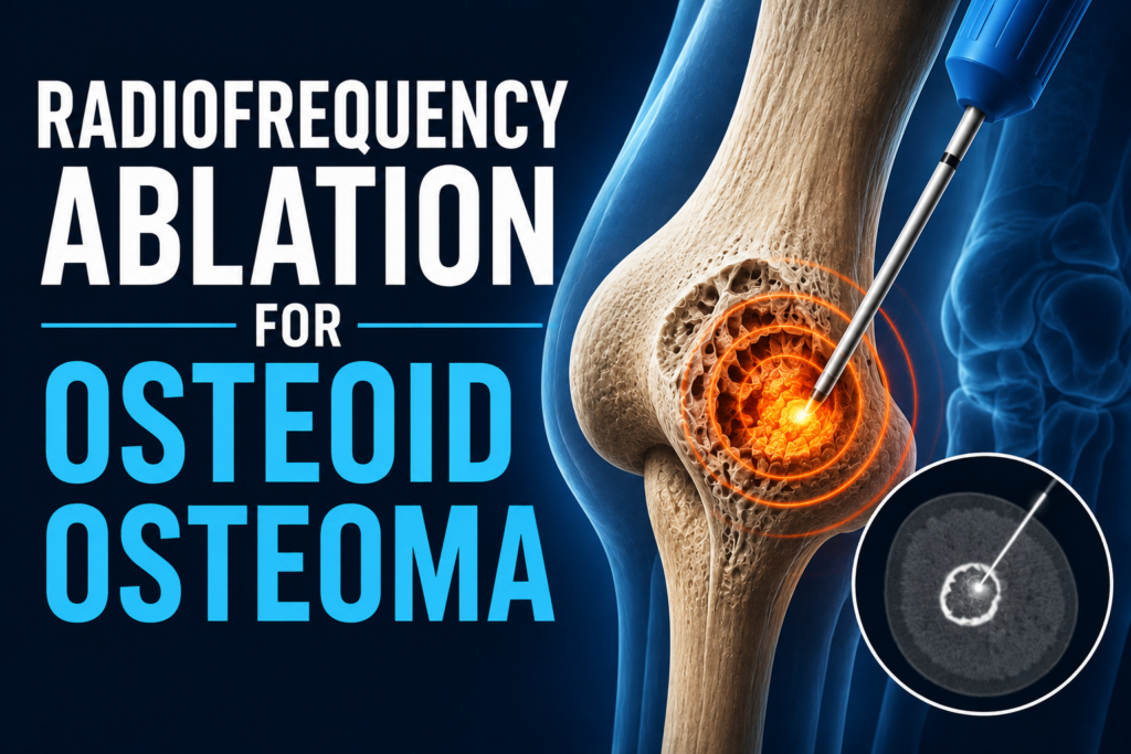 radio frequency ablation