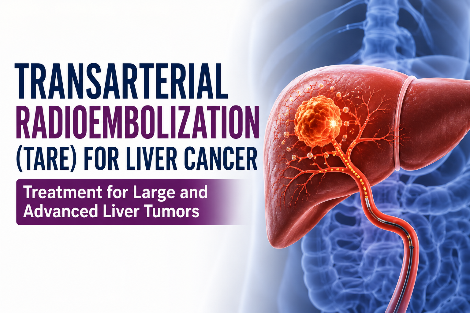 Transarterial Radioembolization (TARE) for Liver Cancer: Treatment for large and advanced liver tumors
