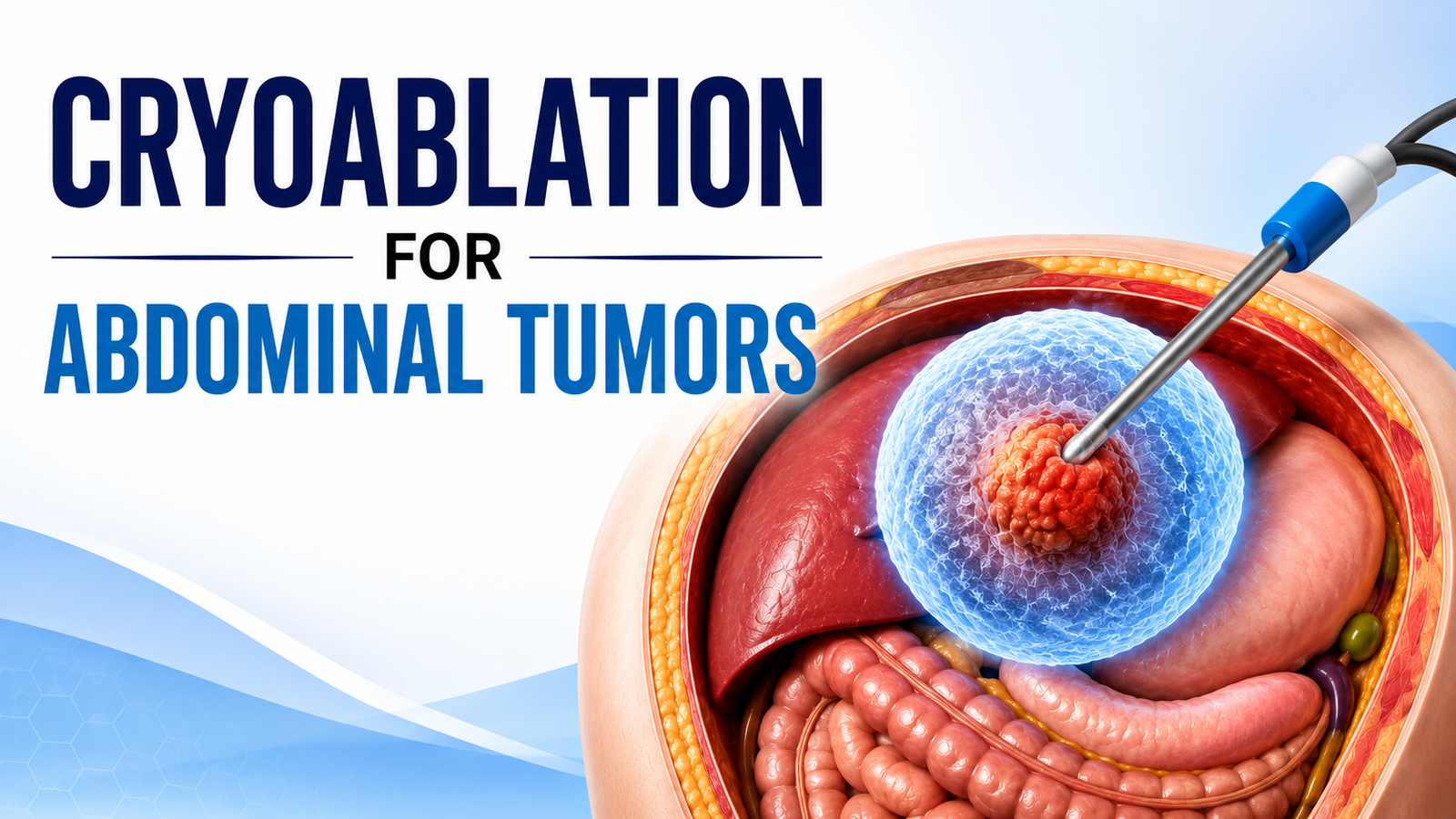 Cryoablation for Abdominal Tumors