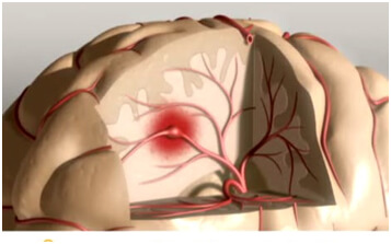 Ischemic Stroke Treatment in Hyderabad