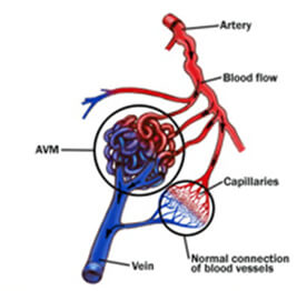 Dural AVM Treatment in India