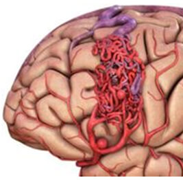 Dural AVM Treatment in Hyderabad