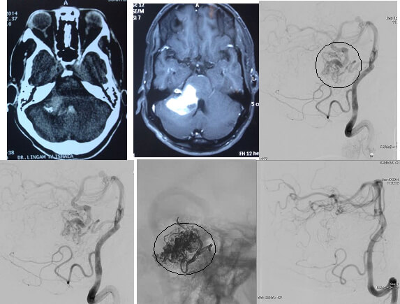 Dural AVM Treatment in India