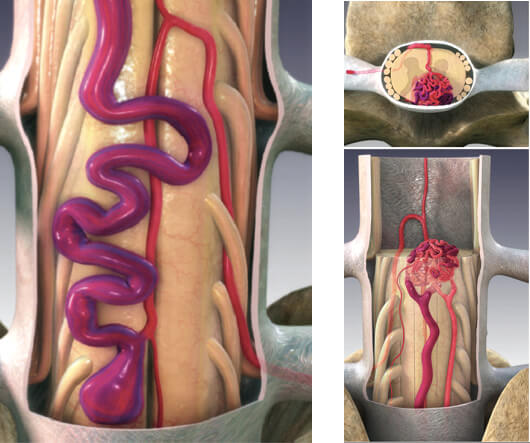 Spinal AVM in Hyderabad