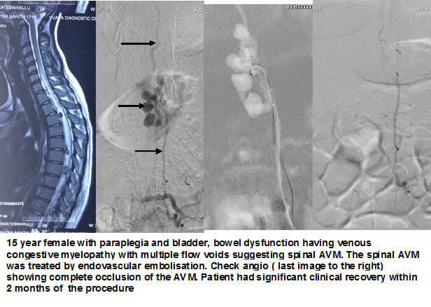 Embolization for Spinal AVM in Hyderabad