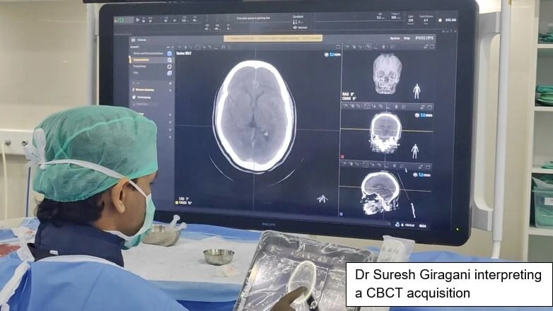 STENT ASSISTED COILING OF ICA ANEURYSM