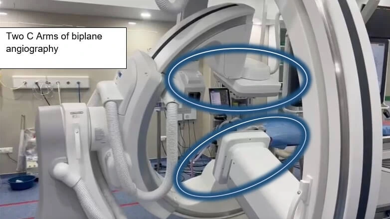 STENT ASSISTED COILING OF ICA ANEURYSM