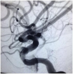 Brain Angiogram in Hyderabad