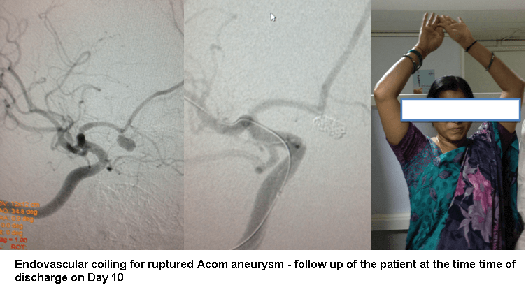 Endovascular Coiling Procedure in Hyderabad