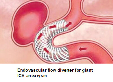 Endovascular Embolization Procedure in Hyderabad