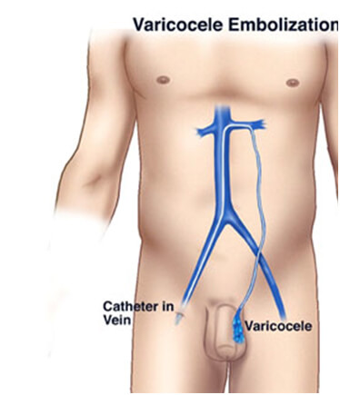 Treatment Options - : Symptoms, Treatment and Varicocele  Embolization: Symptoms, Treatment and Varicocele Embolization