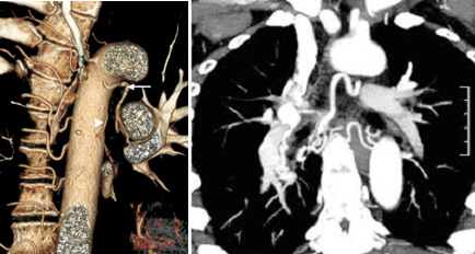 Endovascular Embolization Procedure in Hyderabad