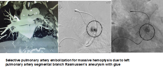 Prostate Artery Embolization in Hyderabad