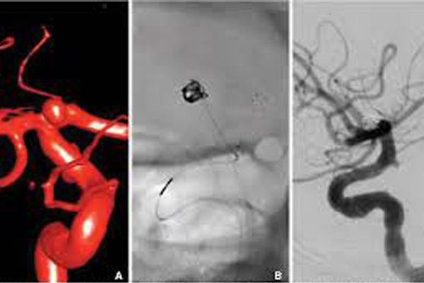 Coiling For Aneurysms Tratment in Hyderabad