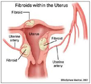 Uterine Fibroid Embolization treatment in Hyderabad