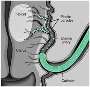 Interventional Radiology Treatments in Hyderabad