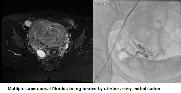 Uterine Fibroid Treatment in Hyderabad