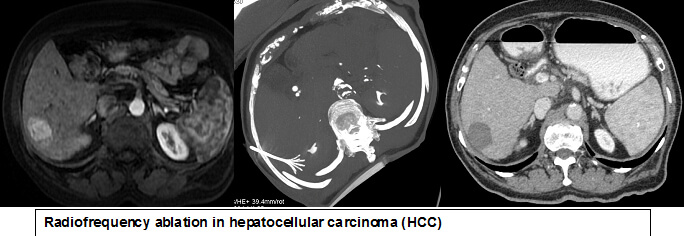 Liver Cancer Treatments in Hyderabad