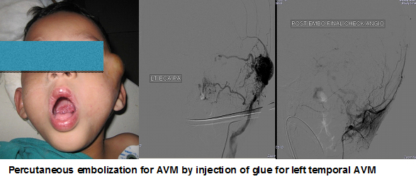 Pelvic Congestion Syndrome Treatments in Hyderabad