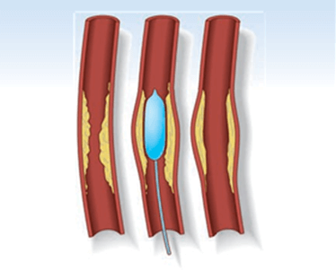 Vascular Malformations Treatment in Hyderabad