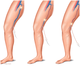 Vena Block & VenaSeal Treatments for Varicose Veins