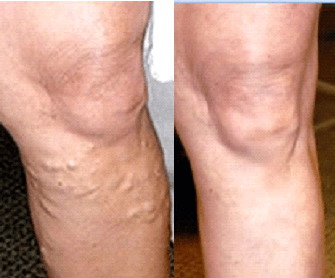 Vena Block & VenaSeal Treatments for Varicose Veins